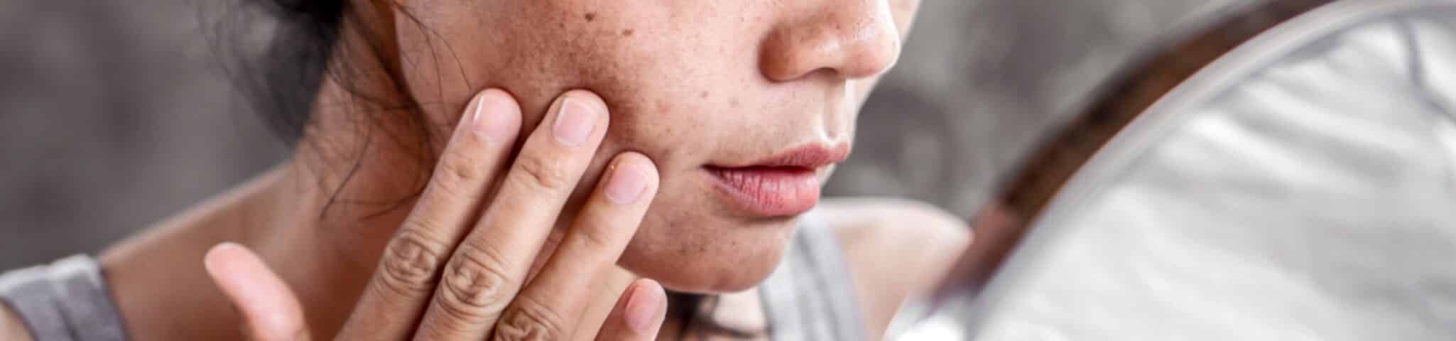 sun spots treatment aventura FL