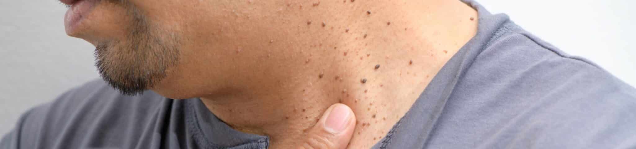 Close-up of a model's neck and jaw with many small skin tags