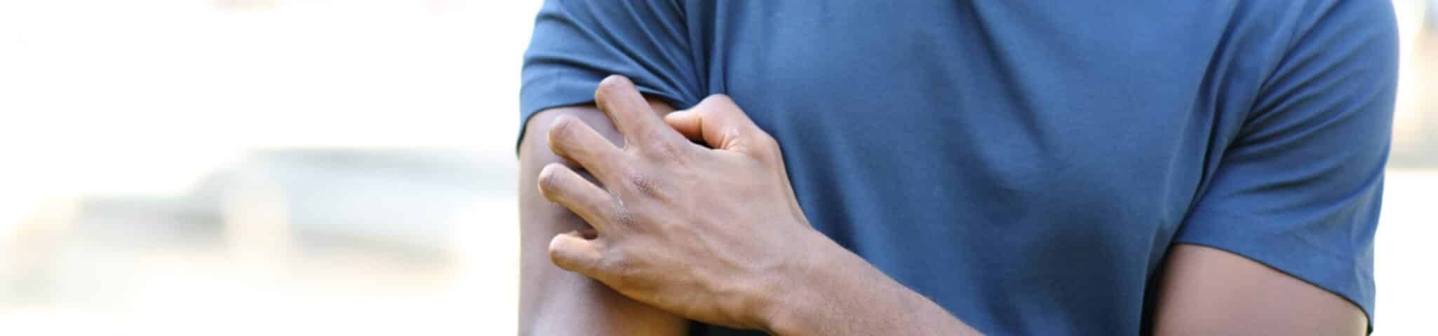 eczema treatment aventura FL