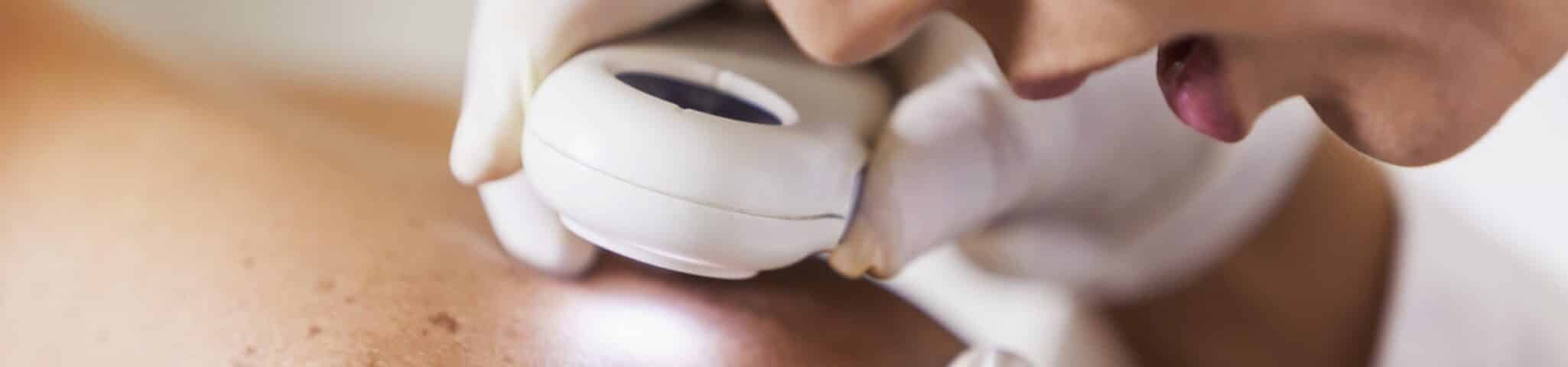 skin cancer treatment aventura FL