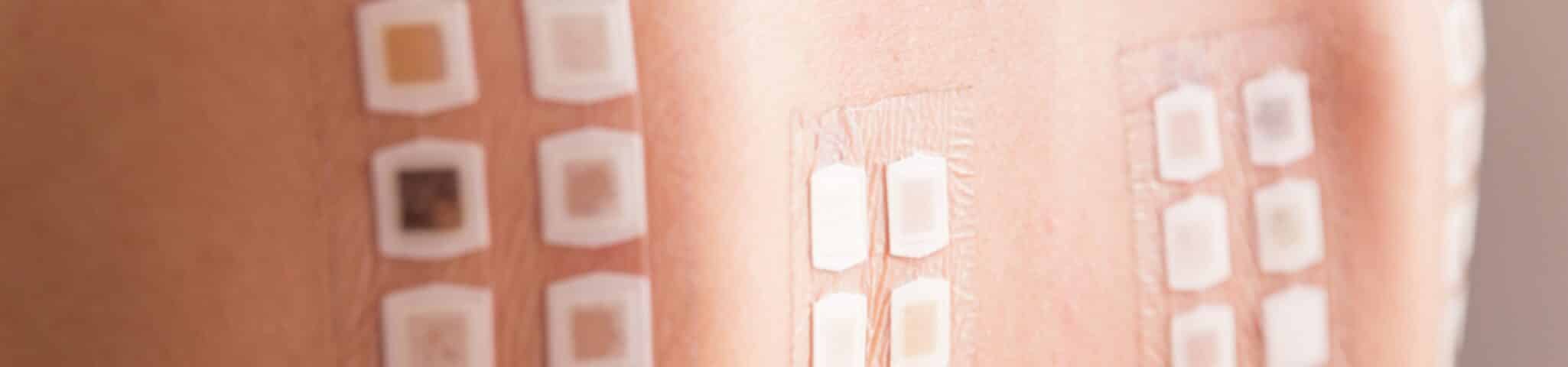 skin patch testing aventura FL