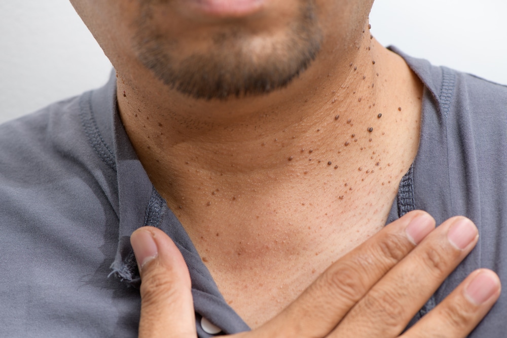Close up of a man with multiple skin tags covering his neck, perhaps in need of removal treatment.