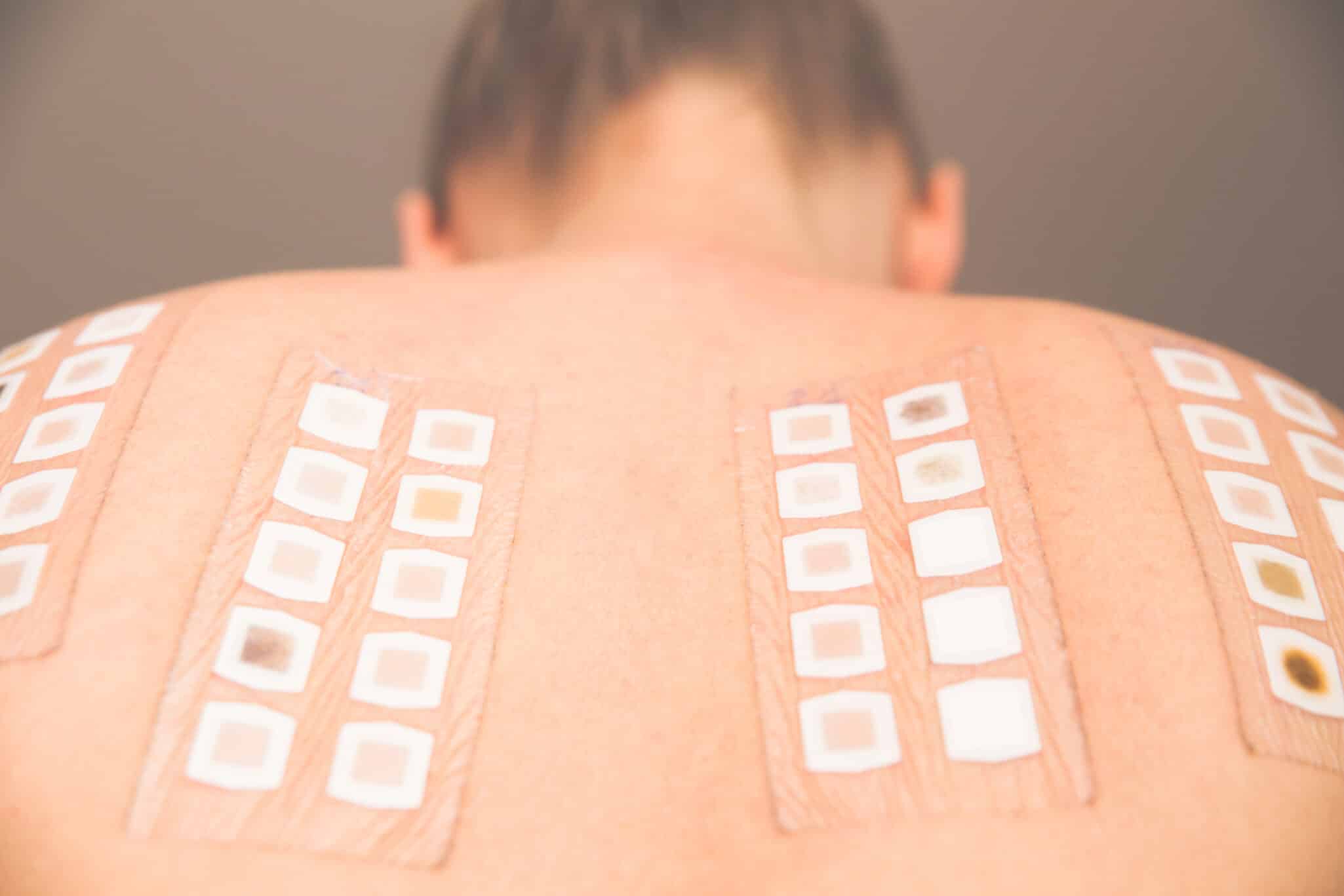 Close up of a patient getting a patch test done on their back to find the cause of skin sensitivity