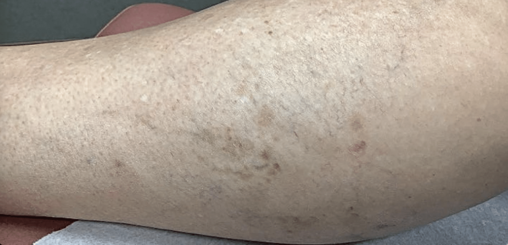 After Image: Sclerotherapy - left-side