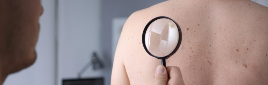 dermatologist looking at patient's moles on back through magnifying glass