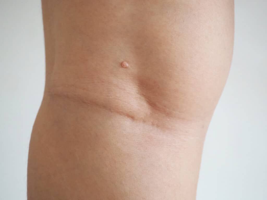 skin tag on back of knee