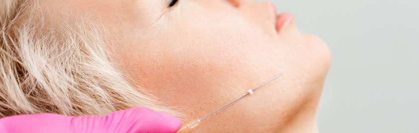 woman undergoing PDO thread lift with needle in cheek