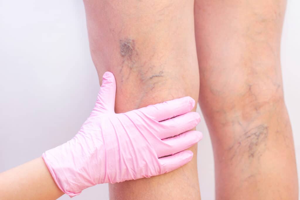 A dermagologist examining patients calves with large spider veins.