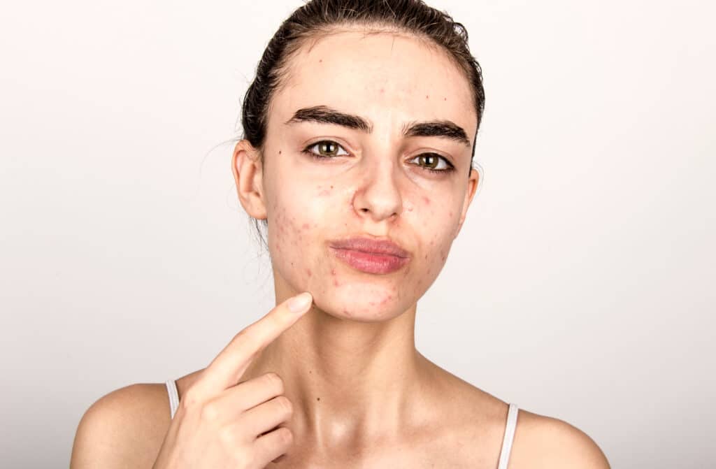 beautiful young girl with problematic skin, acne problem concept