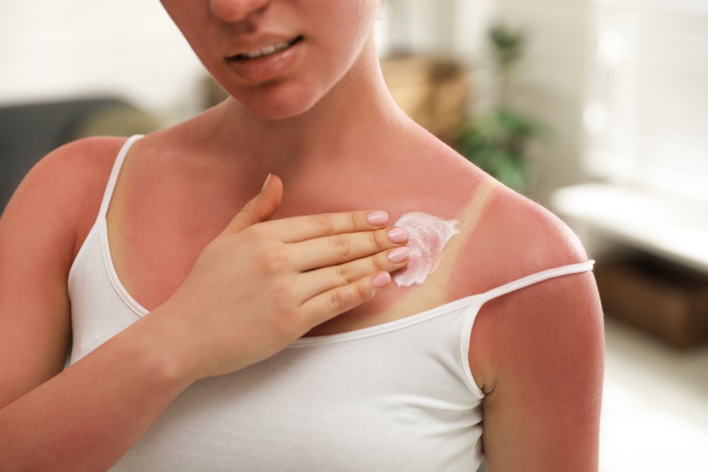 Woman applying soothing cream to her chest after getting a painful sun burn.