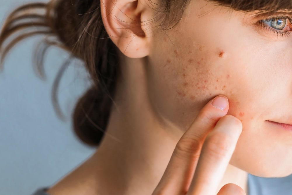 Close up of a woman with persistent acne on her cheeks, in need of dermatology treatment.