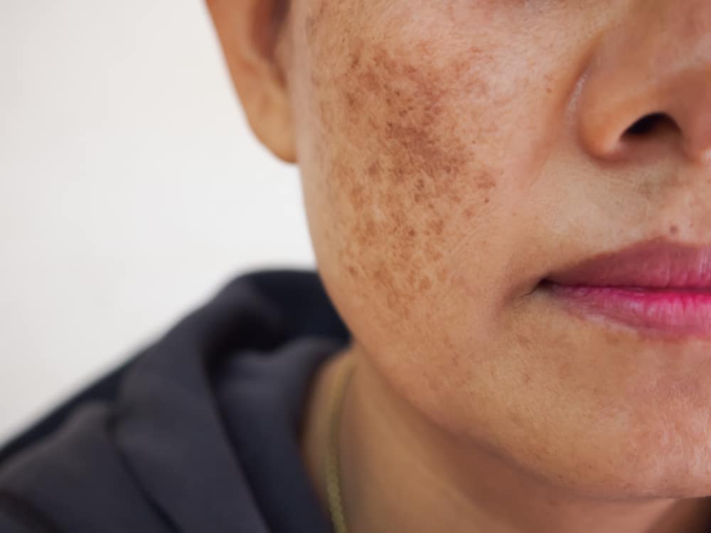 Close up of a woman with prominent brown melasma spots on her cheek.
