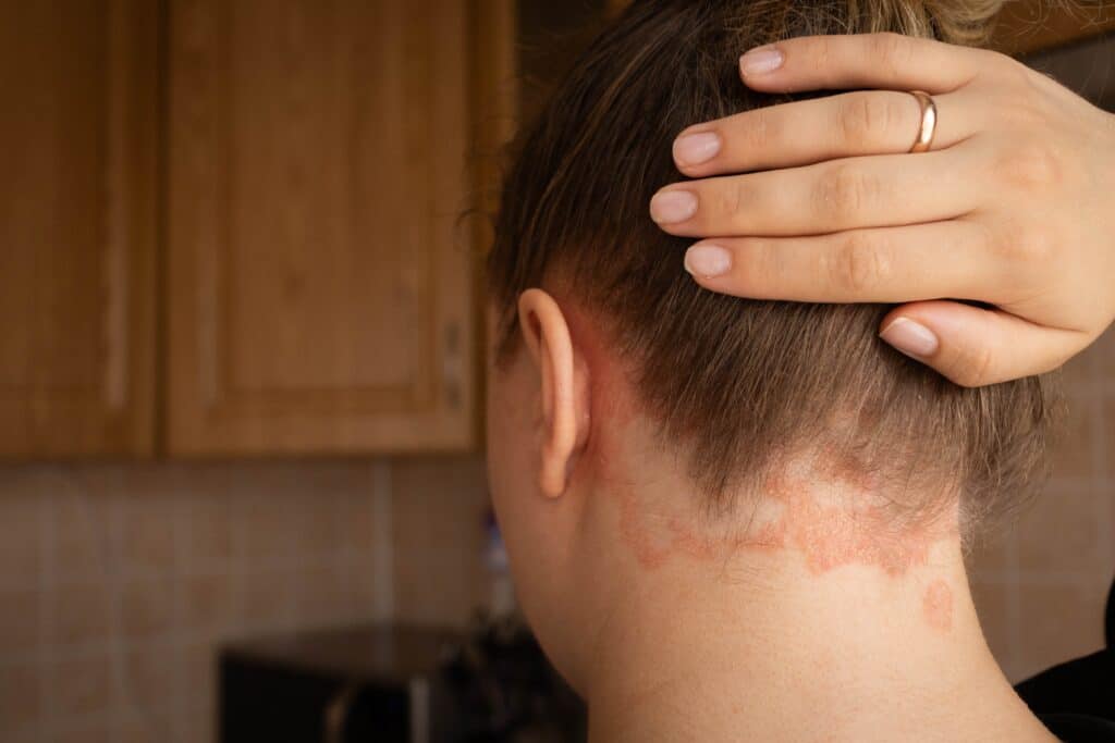 Woman pulling up the hair on the back of her neck to show the psoriasis patches in her hairline