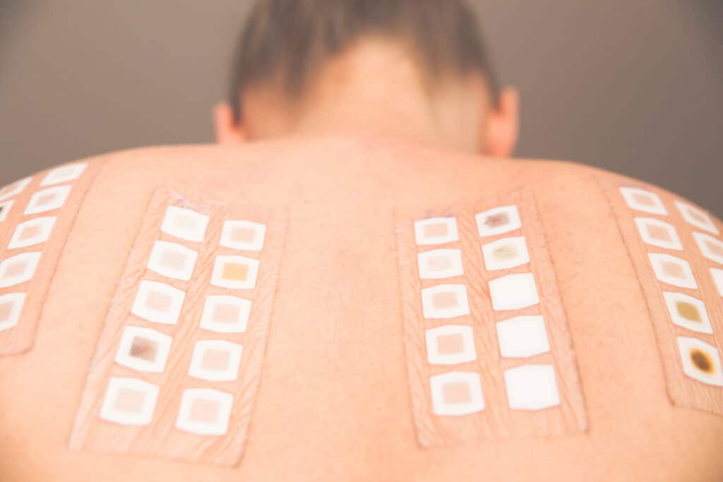 Close up of a patient getting a patch test done on their back to find the cause of skin sensitivity