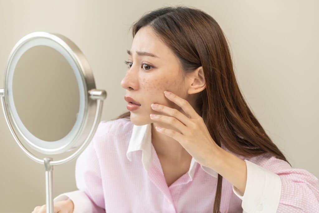 Young woman looking at the dark spots on her cheeks in the mirror, in need of skin treatment