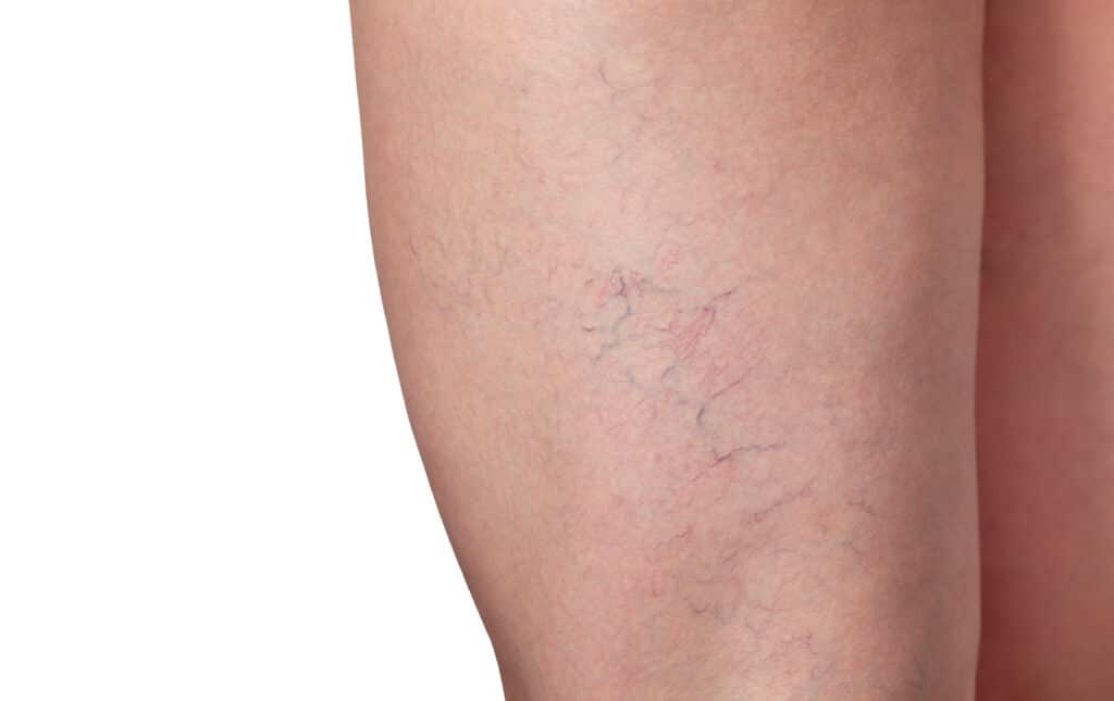 Close up of a patient's thigh with spider veins spread over it, in need of sclerotherapy
