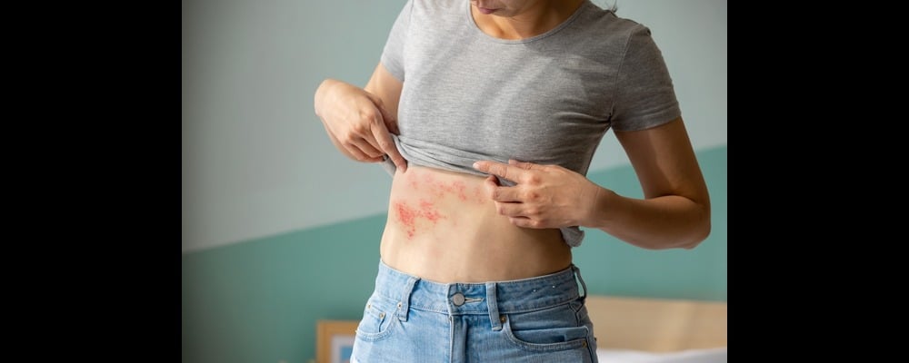Close up of a woman lifting up her shirt to show an unknown rash on her abdomen, in need of professional treatment.