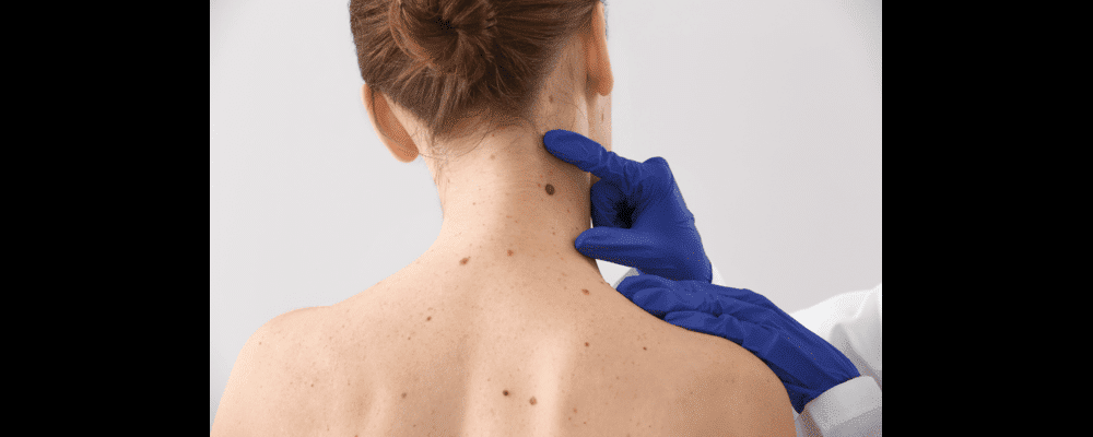 Woman having a large, dark, and textured mole on her neck examined by her dermatologist.
