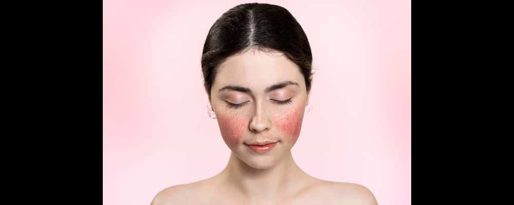 Pretty young woman with her eyes closed and bright pink rosacea spots on her cheeks, suffering from a flare-up.