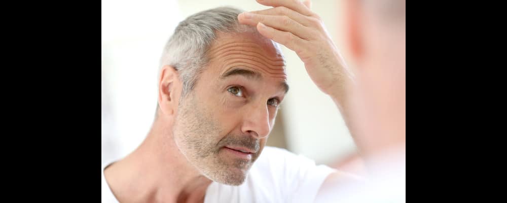 Close-up of a man's head with flaking and irritation, potentially a psoriasis issue.