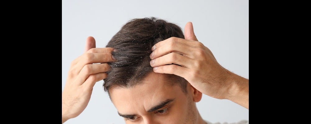 Close-up of a man's head with flaking and irritation, potentially a psoriasis issue.
